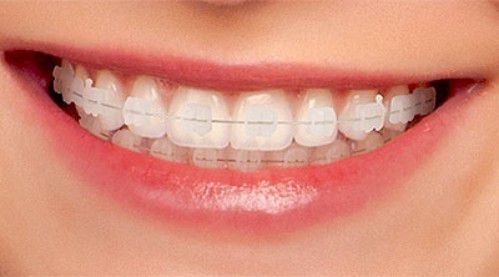 Các phương pháp niềng răng thẩm mỹ - Niềng răng chuyên sâu