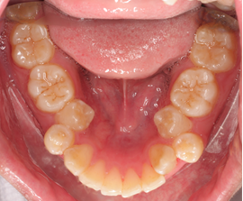 Niềng răng lệch lạc – Răng đẹp dễ thành công