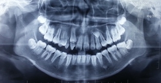 Răng ngầm xử trí thế nào ( phần 2 )